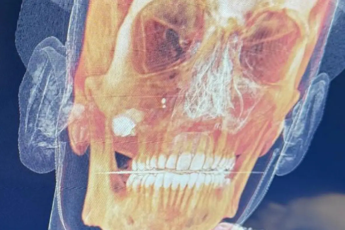 Canadian Man Still Waiting Eight Days for Bullet to Be Removed. Thanks, Socialized Medicine!