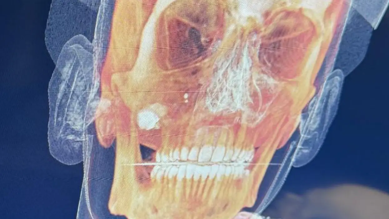 Canadian Man Still Waiting Eight Days for Bullet to Be Removed. Thanks, Socialized Medicine!