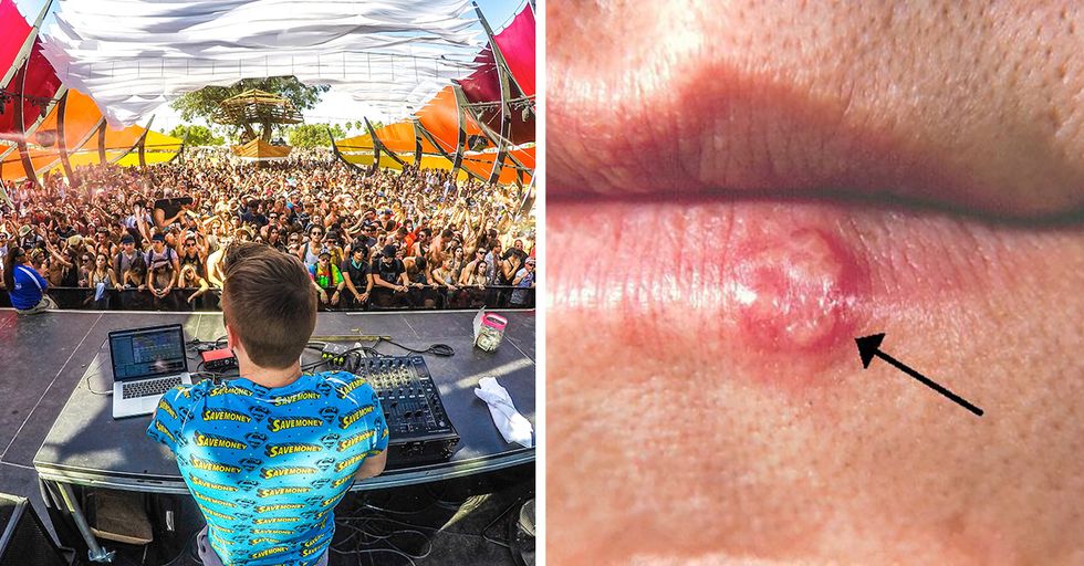 Massive Outbreak of Herpes at Coachella Music Festival