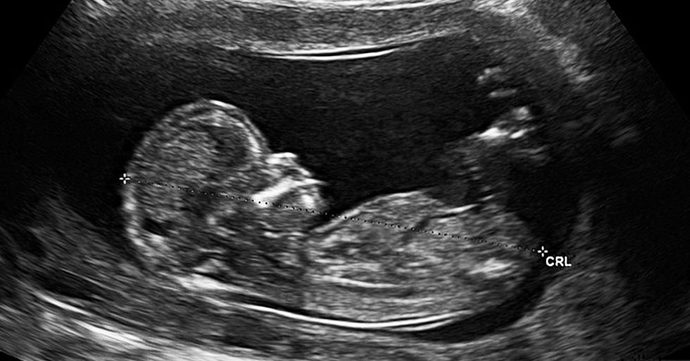 No, You Sick F*cks, It's Not Compassionate to Abort Your Baby