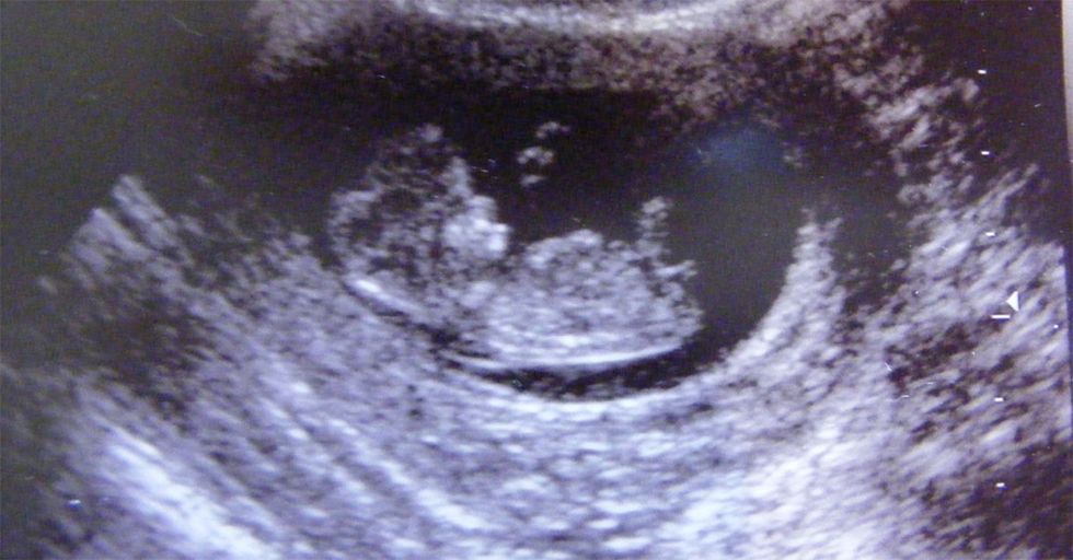 Alabama Judge Allows Father to Sue on Behalf of His Aborted Child
