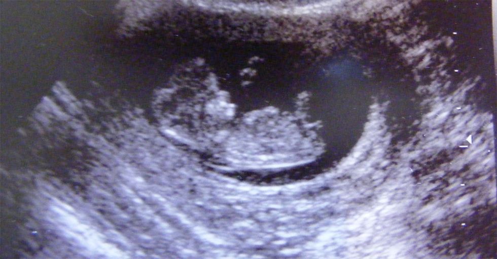 Alabama Judge Allows Father to Sue on Behalf of His Aborted Child