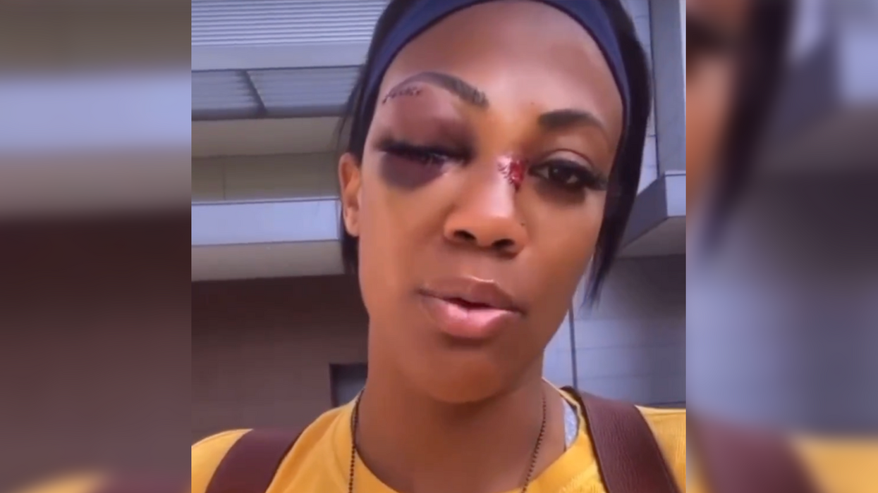Olympian Gets Assaulted By Homeless Man on the Crime-Infested Streets of Los Angeles and She's Speaking Out